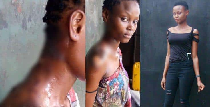 Lady scalded with hot water while trying to separate a fight in Port Harcourt