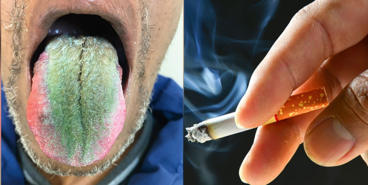 Man grows green hairs on his tongue following alleged reaction to smoking cigarettes while on antibiotics