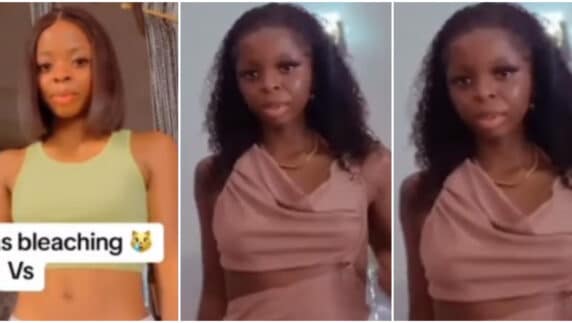 Lady shares before and after photos of her skin after stopping using bleaching cream (Video)