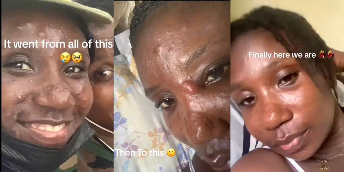 Beautiful lady shares transformation after dealing with intense acne