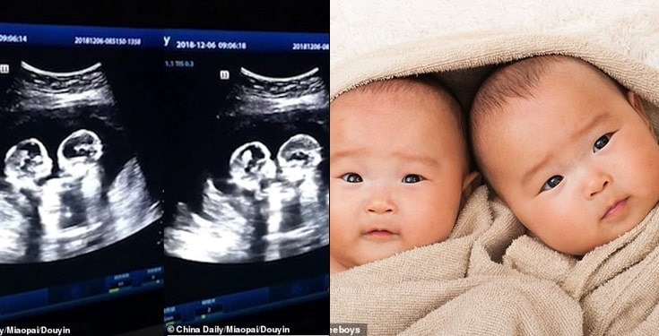 Identical twin sisters spotted 'fighting' in mother's womb during ultrasound scan