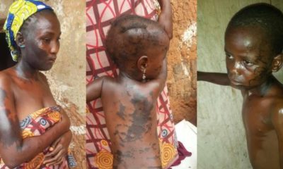 Man divorces his wife, douses her and their kids with acid