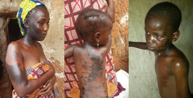 Man divorces his wife, douses her and their kids with acid