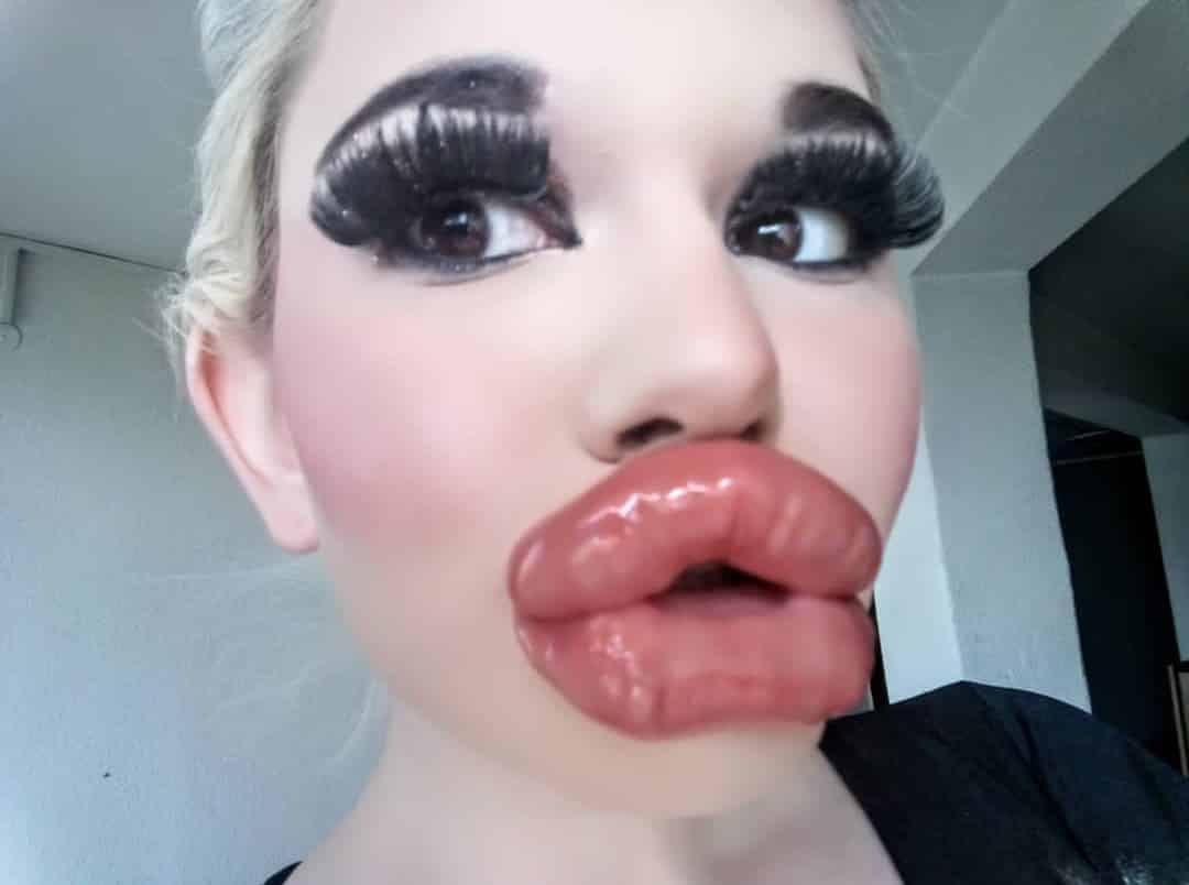 Real Life Barbie Shows Off Giant Lips After Th Filler Injection Video