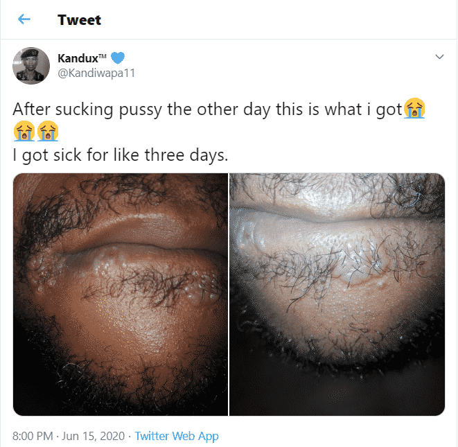 Man reveals what happened to his lips and tongue after oral-sex with a girl (Photos)