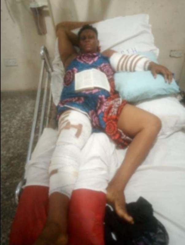 Woman narrates how her husband chopped off her hand over suspicion of infidelity