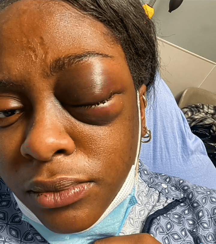 Woman who hailed her boyfriend as the best and flaunted him on social media regrets memories, shows fractured face caused by him (Video)