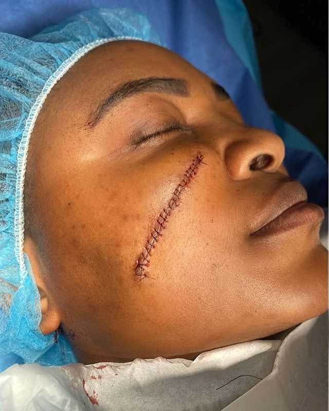How I lost confidence because of scar on my face - Sonia Ogiri narrates as she undergoes surgery