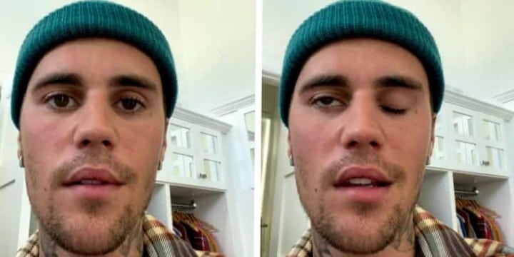 Justin Bieber reveals his face is half-paralyzed after being diagnosed with ramsay hunt syndrome [Video]