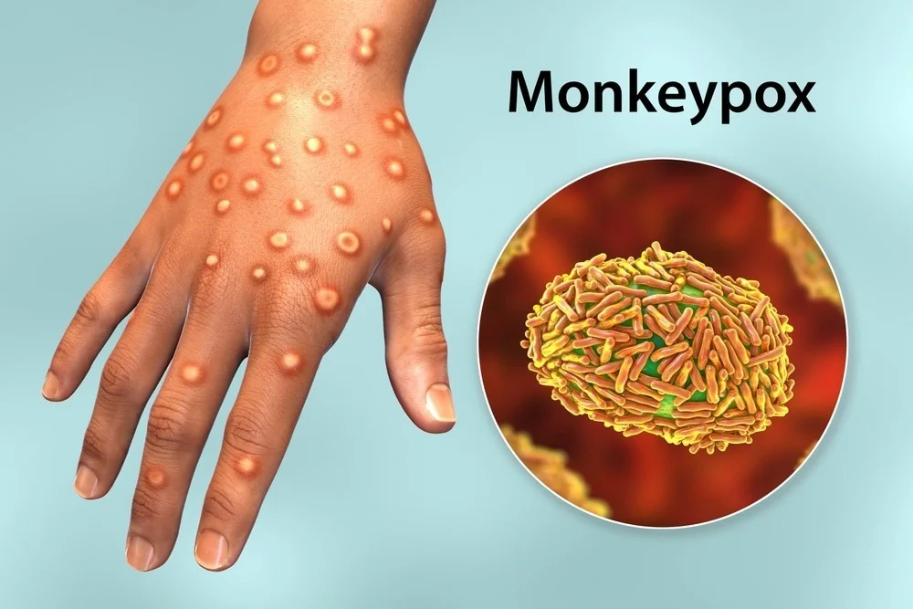 monkeypox