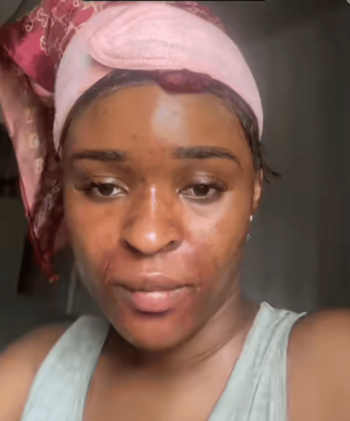 “I don’t deserve this” – Lady cries out as house help mixes substance in her face cream to burn her skin (Video)