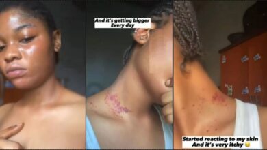 "I use it everyday" — Lady cries out over side effect of contraceptive pills on her skin