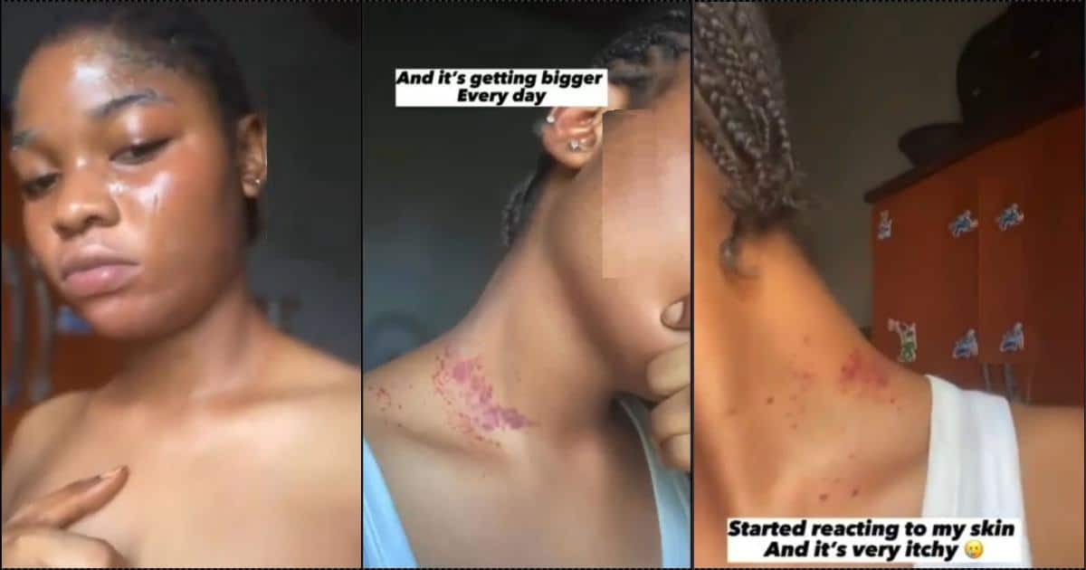 “I use it everyday” — Lady cries out over side effect of contraceptive pills on her skin