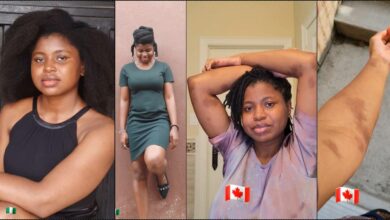 Nigerian lady who hoped for glowing skin battles allergy after relocating to Canada (Video)