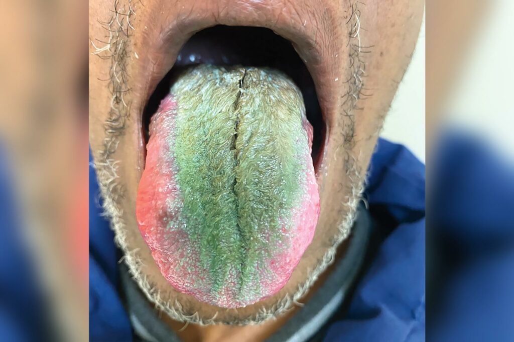 Man grows green hairs on his tongue following alleged reaction to smoking cigarettes while on antibiotics