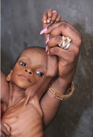 Transformation photos of severely malnourished girl rescued in cross river 6 years ago