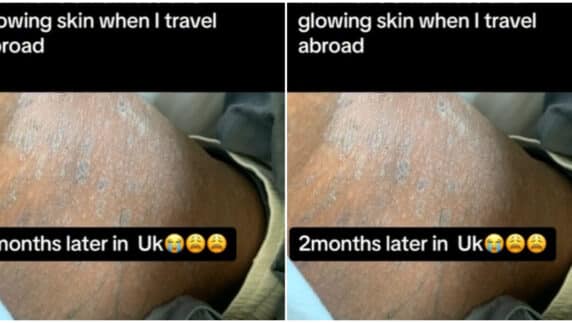 Lady heartbroken as she still battles with skin issue 2 months after arriving in the UK, expects flawless skin (Video)