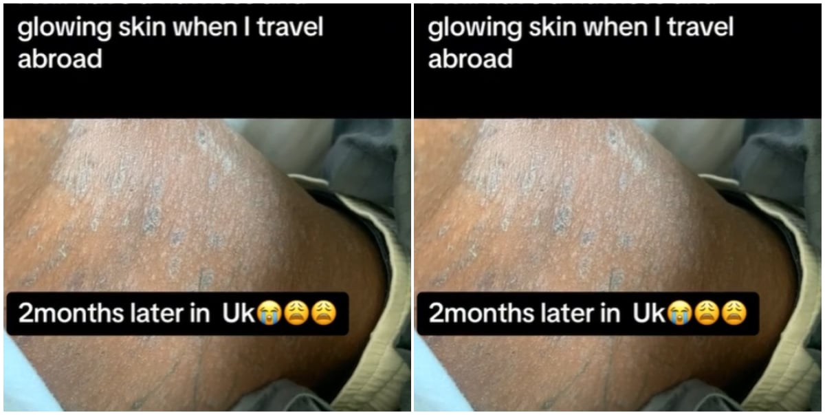 Lady heartbroken as she still battles with skin issue 2 months after arriving in the UK, expects flawless skin (Video)