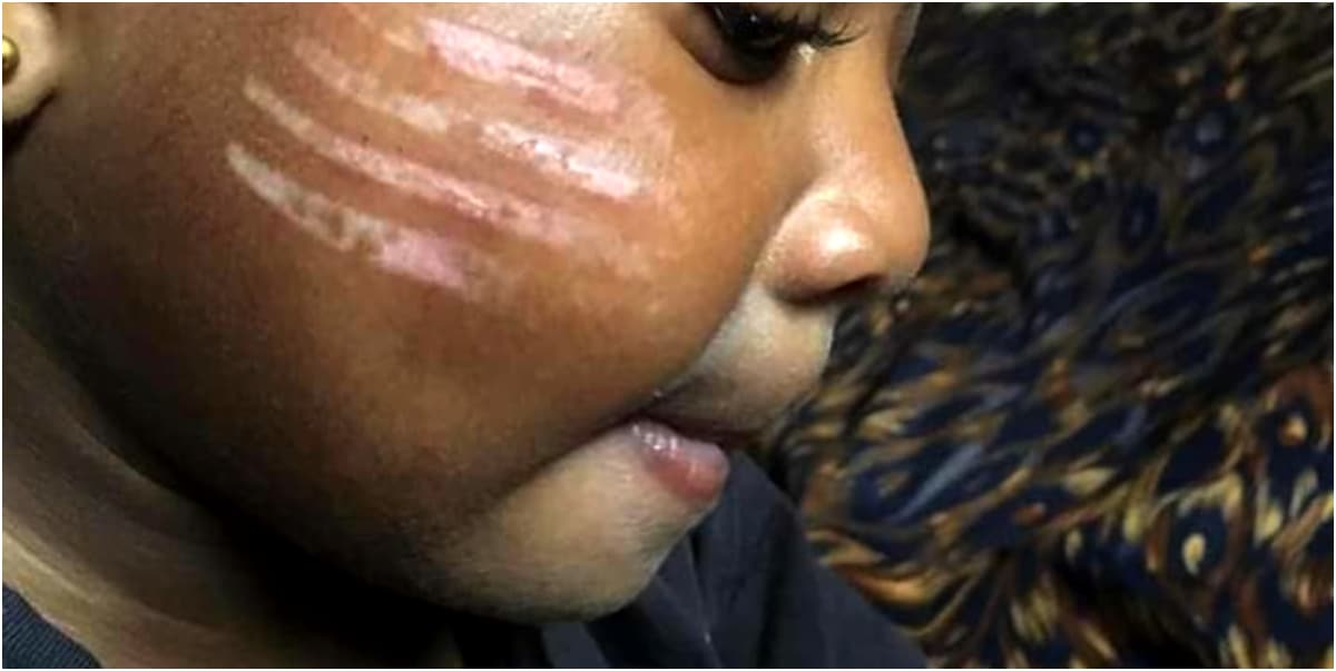 Mother angry as daycare teacher gives child four long tribal marks on cheeks