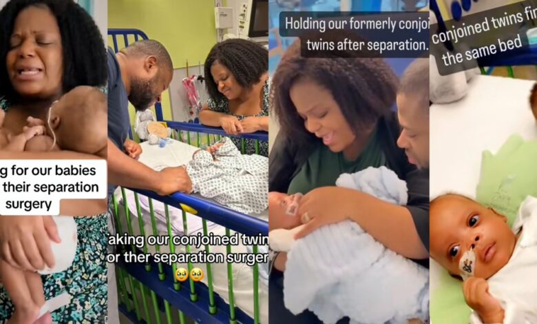 Mother God Conjoined Babies