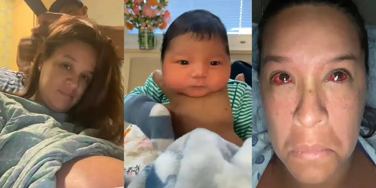 Woman shares how giving birth to her baby explodes her face blood vessels
