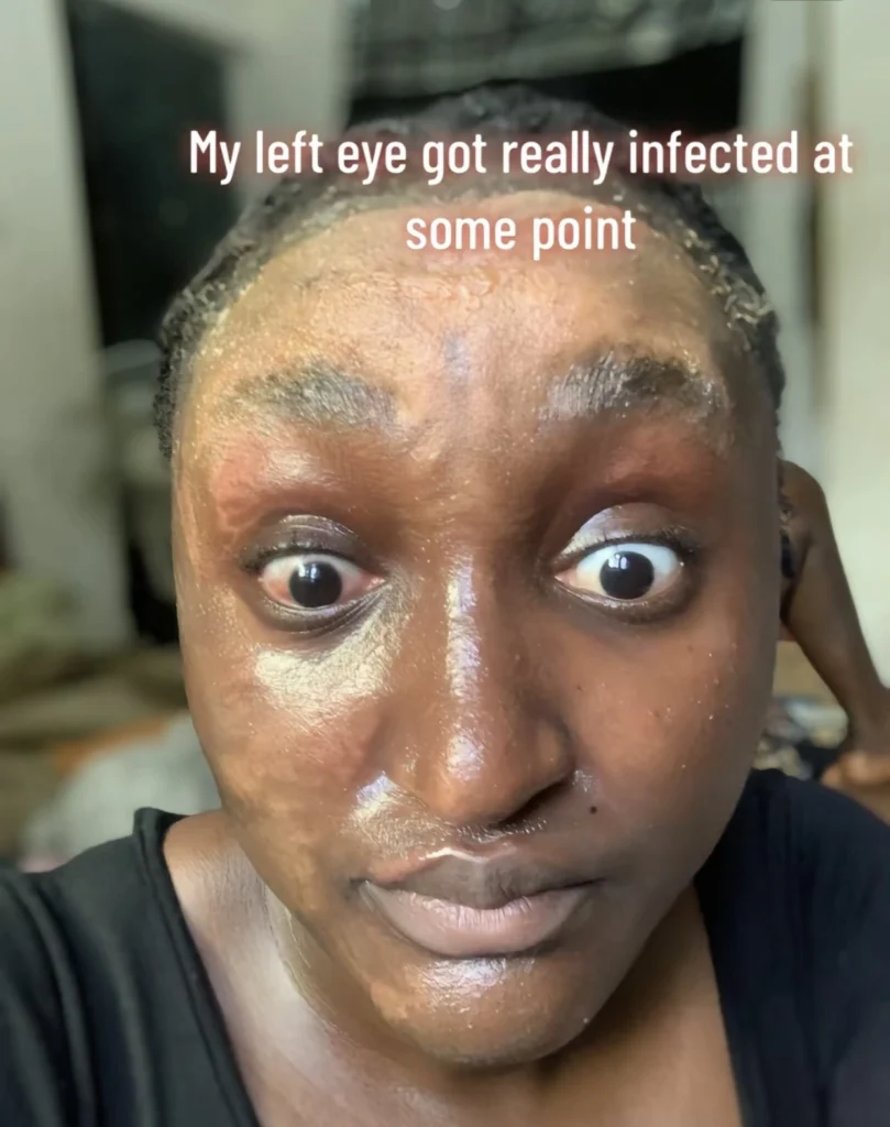 “How lab experiment ruined my face during final year project” — Newly inducted pharmacist 