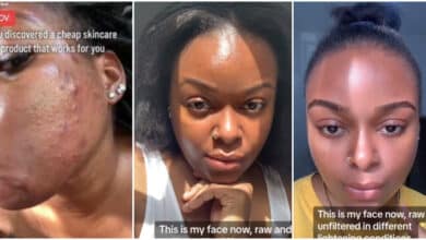 "It cost less than N1k" - Lady who battled severe acne shares skin routine that gave her incredible facial transformation