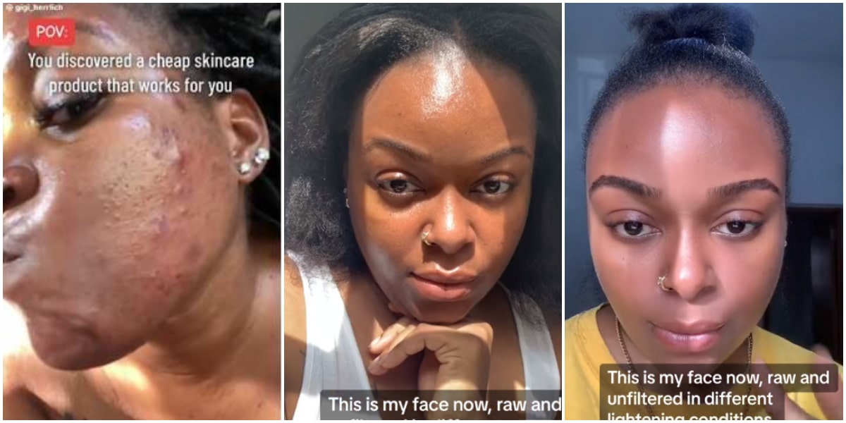 "It cost less than N1k" - Lady who battled severe acne shares skin routine that gave her incredible facial transformation