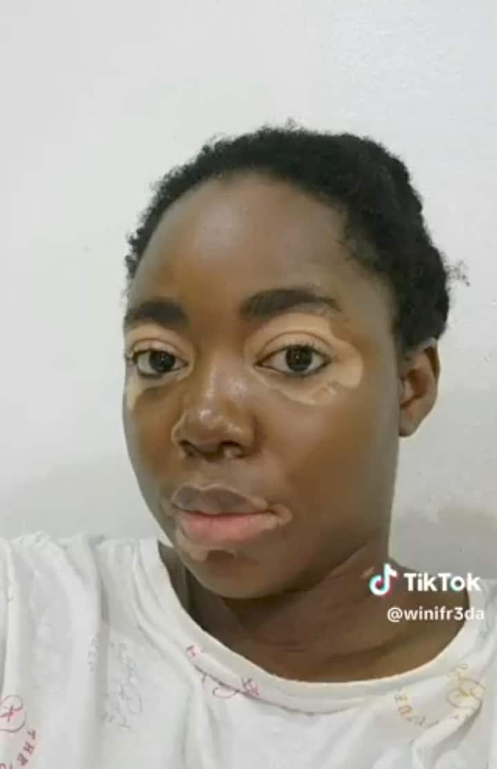 Lady vitiligo 