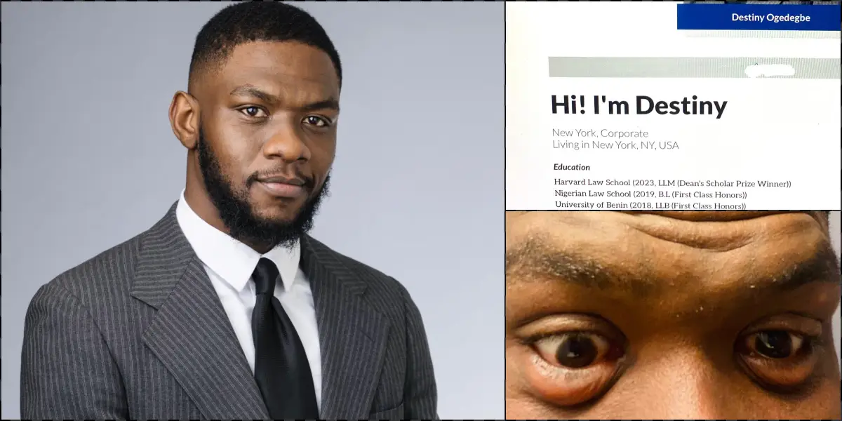 Man shares condition of his eyes after studying 13 hours daily to pass bar exams