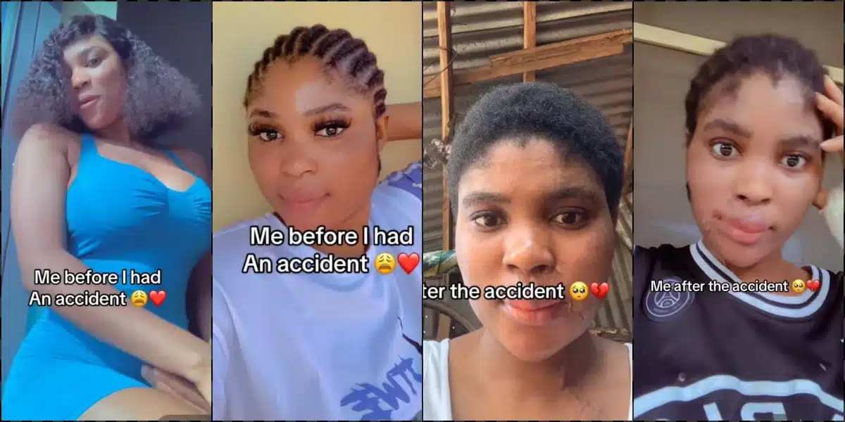 Lady shares transformation after involvement in ghastly accident