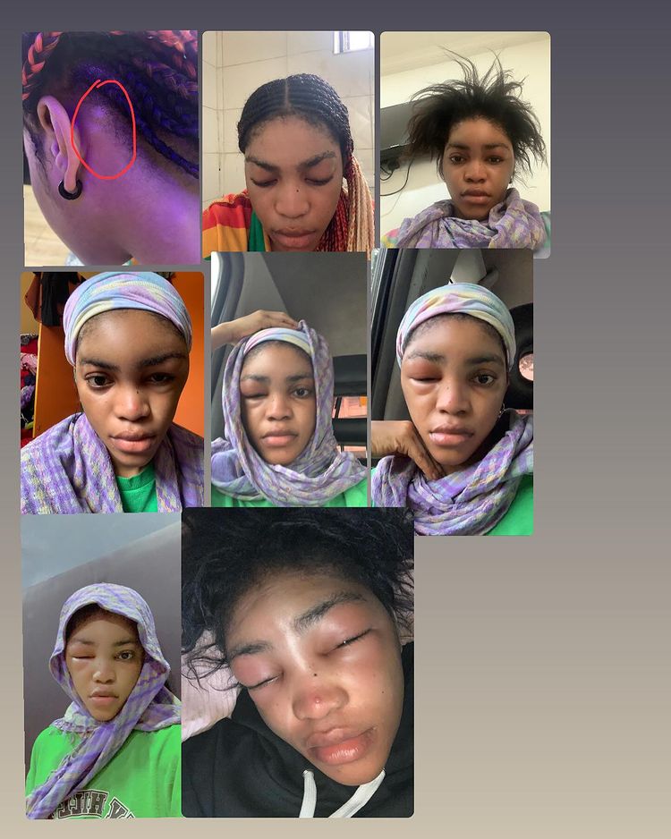 Lil Frosh shares proof, insists swelling on Cute Gemini was allergy not abuse