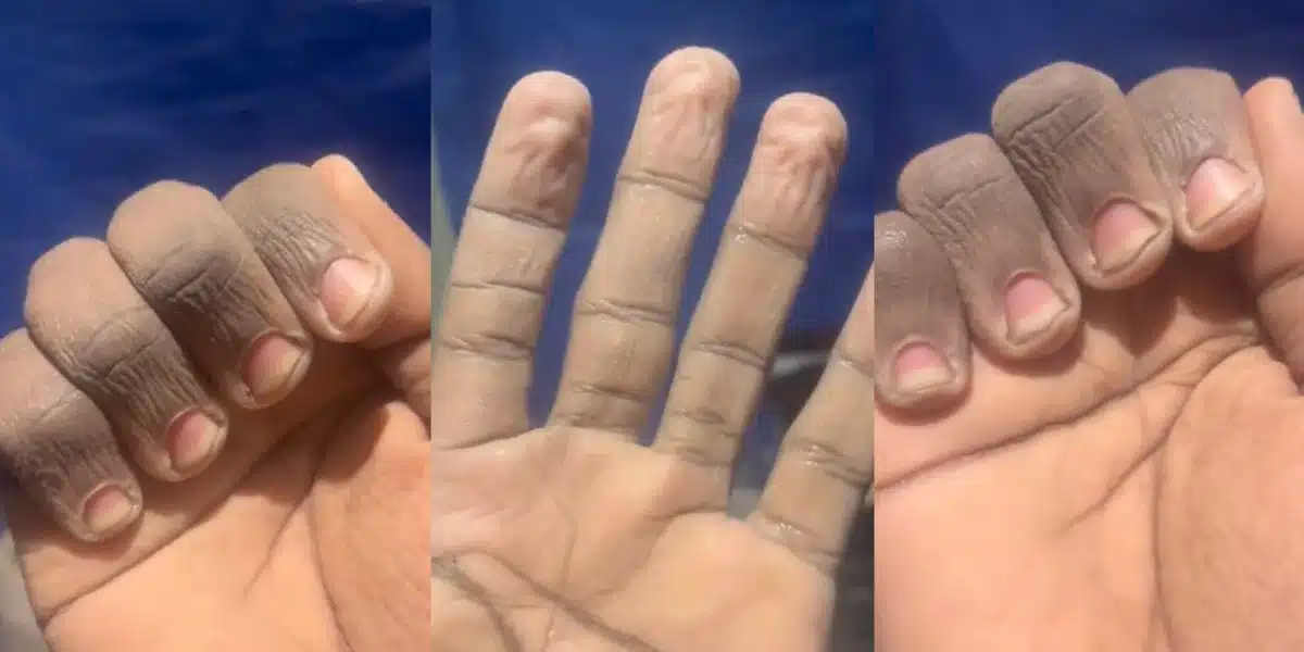 Man shows off state of his hands after washing plates to pay school fees in the UK