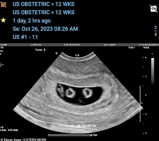 "Beyond belief" - 23-year-old lady pregnant with two sets of identical twins at the same time, it stuns many
