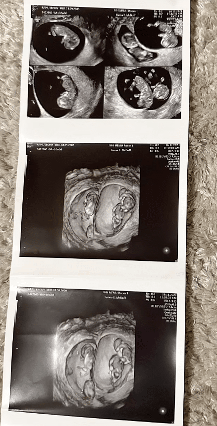 "Beyond belief" - 23-year-old lady pregnant with two sets of identical twins at the same time, it stuns many