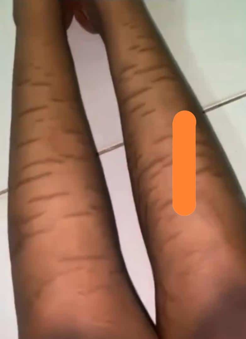 "This is what VDM is fighting against" - Lady cries out following breakout from using skincare products