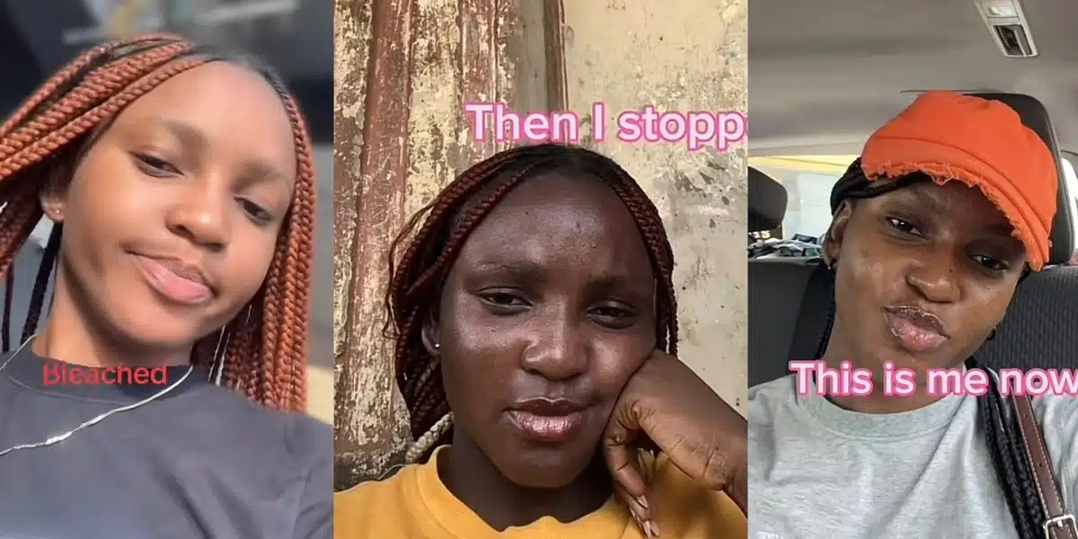 Lady shares her bleaching journey and how she made the tough decision to stop