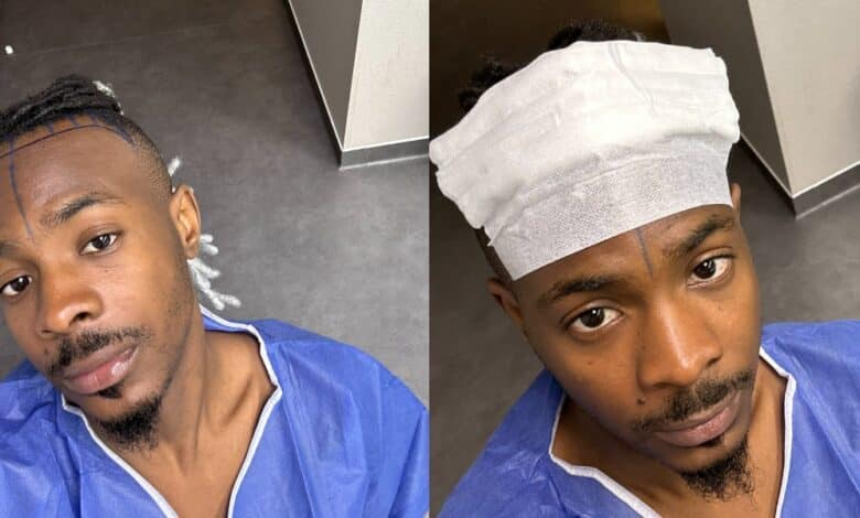 Young Jonn undergoes hair transplant months after being trolled over his receding hairline