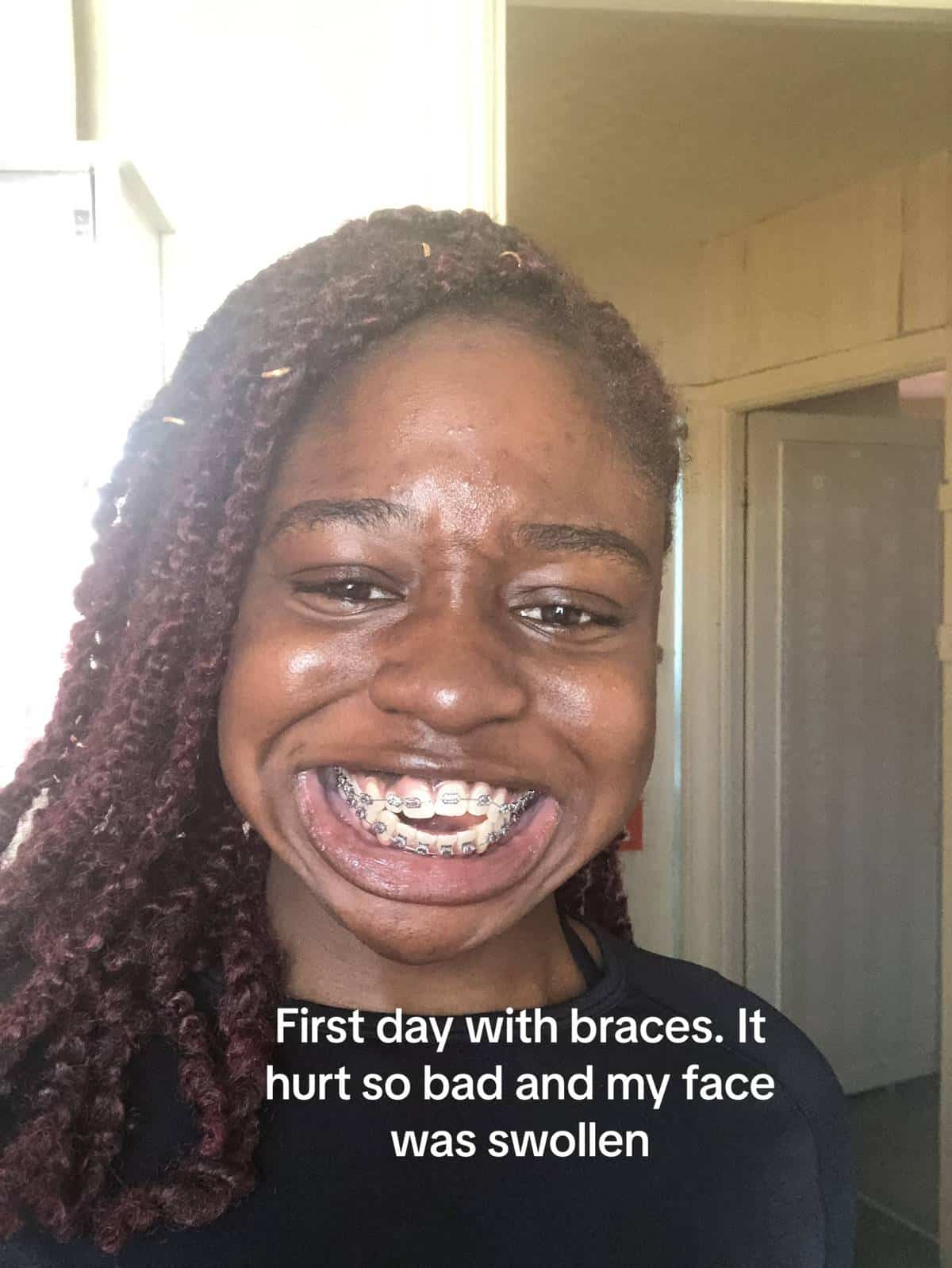 Lady shares beautiful result after wearing braces for five years