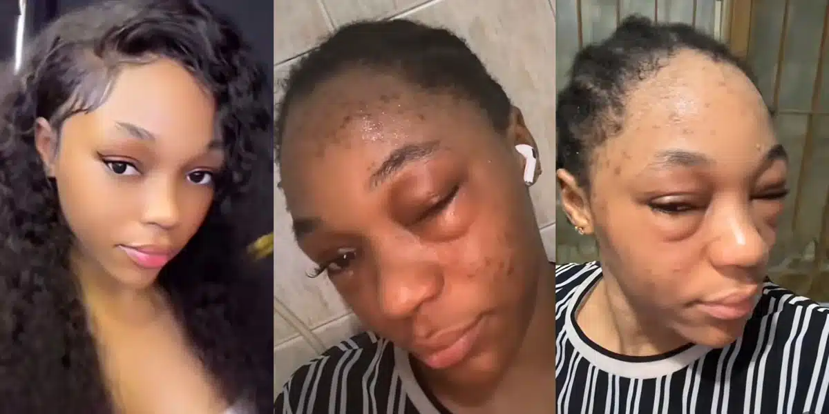 “The left hook wey e give you strong” — Lady who is allergic to alcohol shares proof