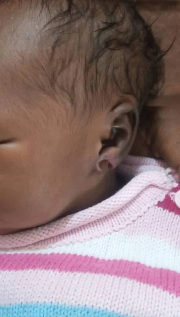 New born nearly loses ear after her mom pierced it when she was only one week old 