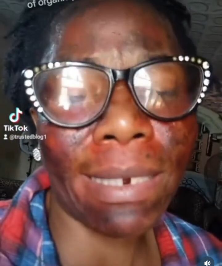 My husband's side chic gave me acid as organic product for face - Woman alleges