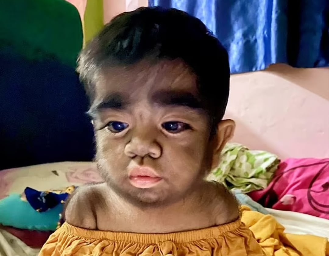 Mother fears son's 'werewolf syndrome' linked to eating cat during pregnancy