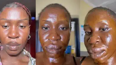 Lady shares the after effect of her allergic reaction to catfish