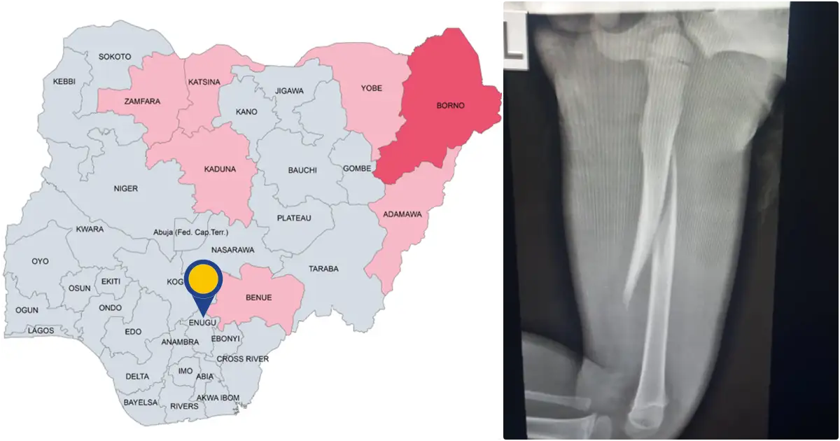 Stepmother breaks 3yearold stepson's bone with pestle in Enugu