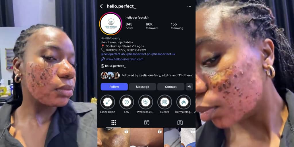 Clinic allegedly vows to jail lady for speaking out after acne treatment results in permanent scar