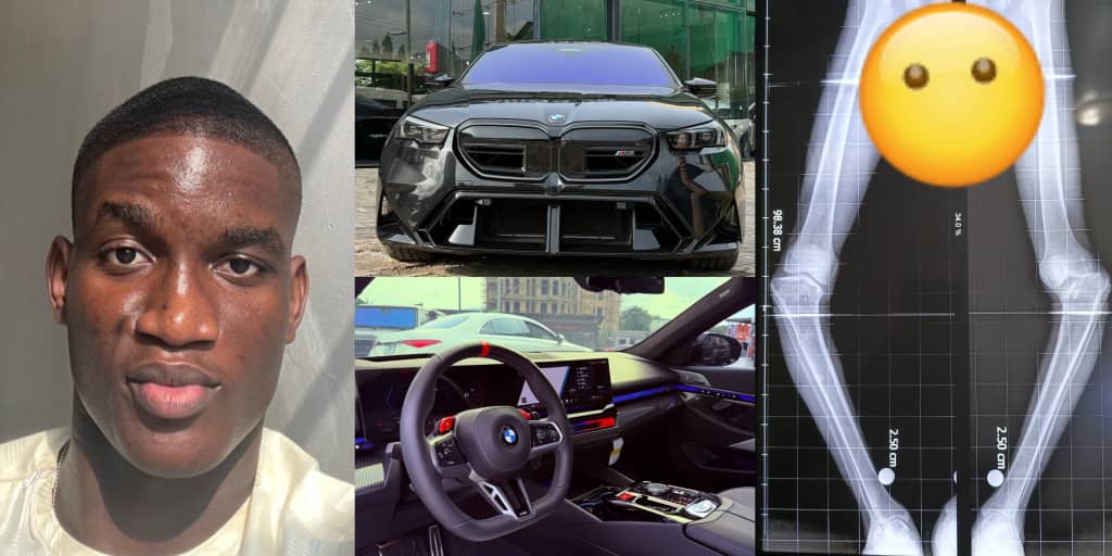 Man reveals desire to own BMW hours after raising ₦22m for leg surgery