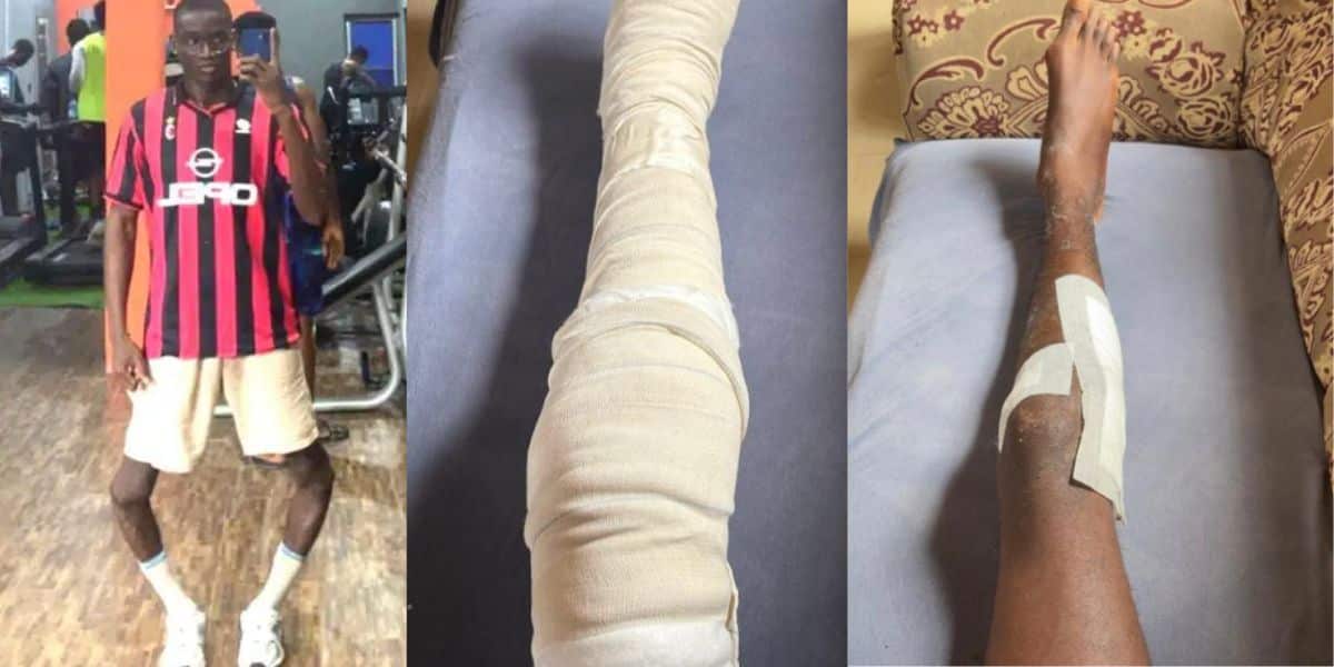 Baddy of Lagos finally removes leg cast, shares post-surgery recovery progress