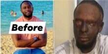 “Life can change in a minute” - Man reportedly loses both eyes after acid attack