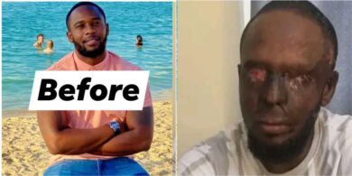 “Life can change in a minute” - Man reportedly loses both eyes after acid attack